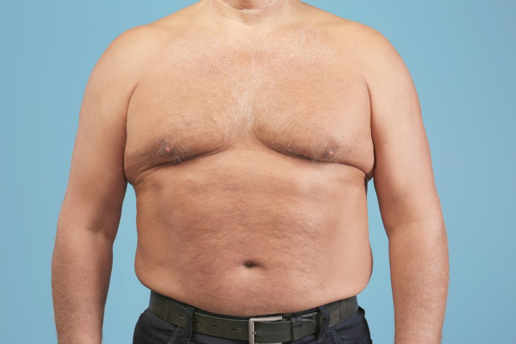 Gynecomastia Surgery